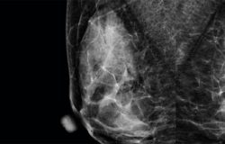 Microcalcificaciones